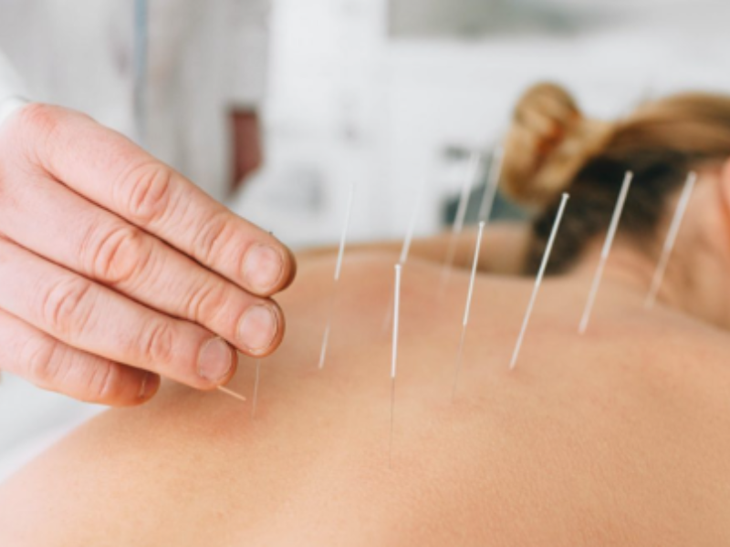 Dry Needling Therapy